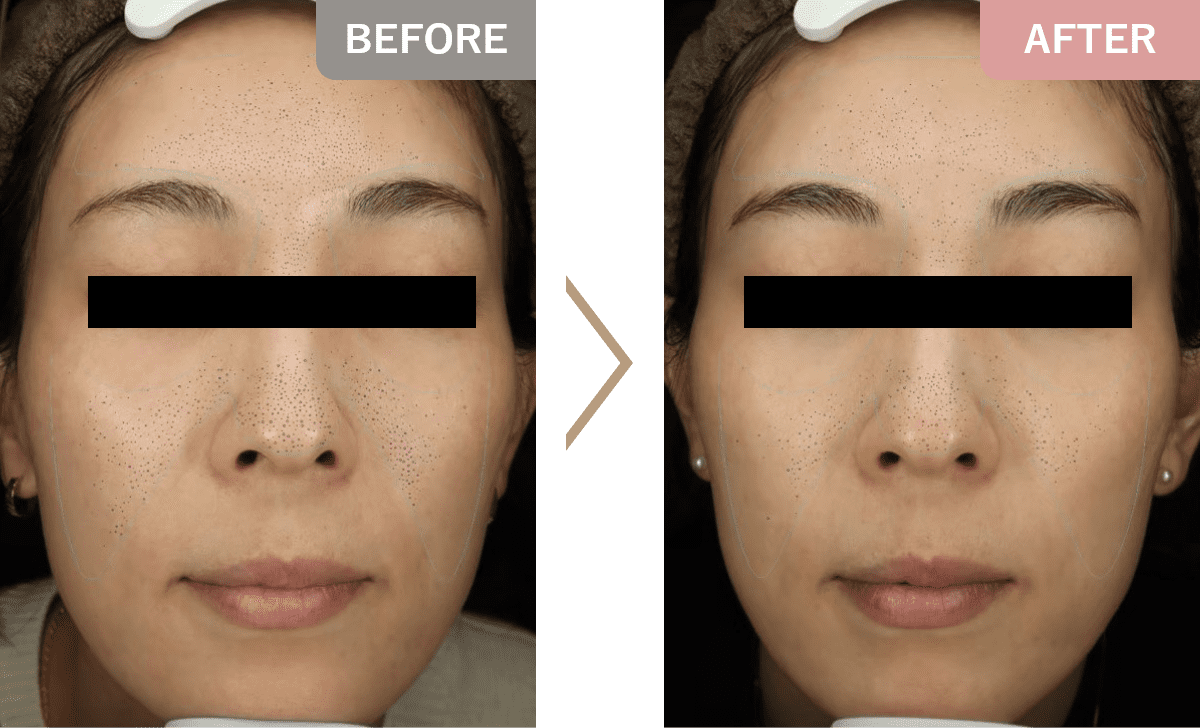 ACRS2回後（目の下は手打ちも2回行いました） VISIAの毛穴スコアは10%→59%に改善しました。お顔全体のトーンも上がり、透明感が得られました。